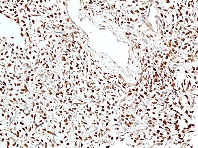 Immunohistochemical staining of formalin fixed and paraffin embedded human solitary fibrous tumor tissue sections using Anti-Stat6 antibody (RM473) at 1:100 dilution.