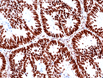 Immunohistochemical staining of formalin fixed and paraffin embedded human colon cancer tissues with MSH2 expression, using anti-MSH2 rabbit monoclonal antibody (Clone RM478) at a 1:100 dilution.