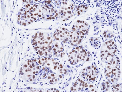 Immunohistochemical staining of formalin fixed and paraffin embedded human breast pleomorphic lobular carcinoma tissue section using anti-GATA3 Rabbit Monoclonal Antibody (RM482) at 1:100 dilution for 1 hr at room temperature.