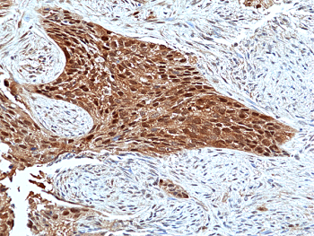 Immunohistochemical staining of formalin-fixed and paraffin-embedded human Lung Squamous Carcinoma tissue sections using Anti-Erk2 antibody (RM483) at 1:100 dilution.