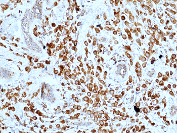 Immunohistochemical staining of formalin fixed and paraffin embedded human breast cancer-lobular section using anti-Muc-1 rabbit monoclonal antibody (Clone RM489) at a 1:1000 dilution.