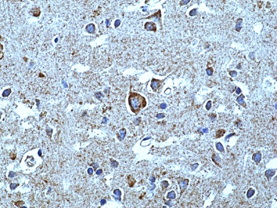 Immunohistochemical staining of formalin fixed and paraffin embedded human Parkinson's Disease Brain [40X] tissue sections using Anti-alpha-synuclein antibody (RM492) at 1:100 dilution.
