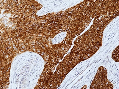 Immunohistochemical staining of formalin fixed and paraffin embedded
human lung squamous carcinoma tissue sections using anti-EGFR
antibody (RM493) at 1:100 dilution.