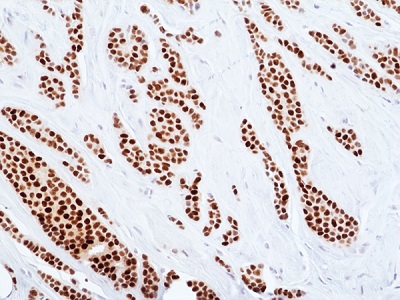 Immunohistochemical staining of formalin-fixed and paraffin-embedded human breast cancer tissue sections using anti-ER-alpha rabbit monoclonal antibody clone RM494 at a 1:100 dilution.