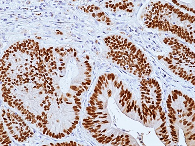 Immunohistochemical staining of formalin-fixed and paraffin-embedded human colon cancer tissue sections using anti-CDX2 rabbit monoclonal antibody clone RM495 at a 1:100 dilution.