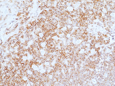 Immunohistochemical staining of formalin-fixed and paraffin-embedded
human Hodgkin lymphoma sections using anti-CD45 rabbit monoclonal
antibody (clone RM497) at a 1:100 dilution.