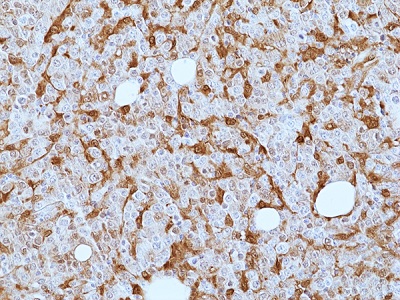 Immunohistochemical staining of formalin-fixed and paraffin-embedded
human diffuse large B cell lymphoma tissue sections using anti-Galectin-9
antibody (RM499) at 1:200 dilution.