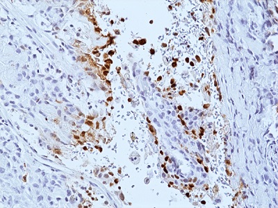 Immunohistochemical staining of formalin-fixed and paraffin-embedded
human lung cancer with radiotherapy, using Phospho-DNA-PKcs (Ser2056)
Rabbit Monoclonal Antibody (Clone RM500) at a 1:500 dilution.