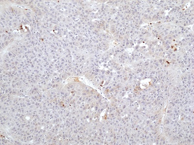 Immunohistochemical staining of formalin-fixed and paraffin-embedded human hepatocellular carcinoma (HCC) tissue sections using anti-FGL1 Rabbit Monoclonal Antibody (RM502) at 1:100 dilution, for 1hr at room temperature.