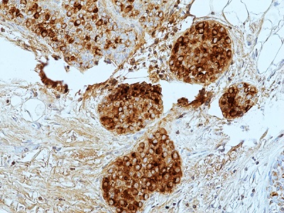 Immunohistochemical staining of formalin-fixed and paraffin-embedded human breast ductal cancer tissue sections using anti-GCDFP-15 Rabbit Monoclonal Antibody (RM504) at 1:100 dilution.