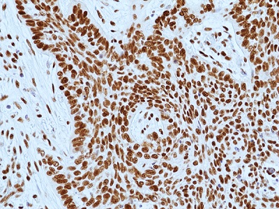 Immunohistochemical staining of formalin-fixed and paraffin-embedded human lung cancer without radiotherapy tissue sections using anti-DNA-PKcs Rabbit Monoclonal Antibody (RM505) at 1:100 dilution.
