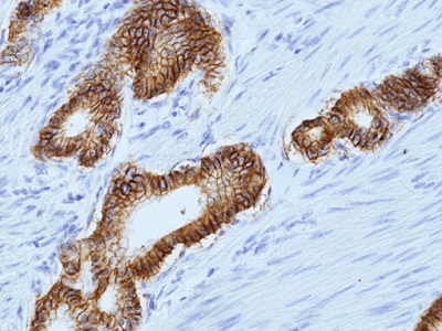 Immunohistochemical staining of formalin-fixed and paraffin-embedded human stomach adenocarcinoma tissue sections using anti-CLDN18.2 Rabbit Monoclonal Antibody, Clone RM510, at 1:100 dilution.