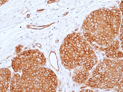 Immunohistochemical staining of formalin-fixed and paraffin-embedded human breast cancer tissue sections using anti-CD155 Rabbit Monoclonal Antibody (Clone RM514) at 1:500 dilution for 1 hr at room temperature.