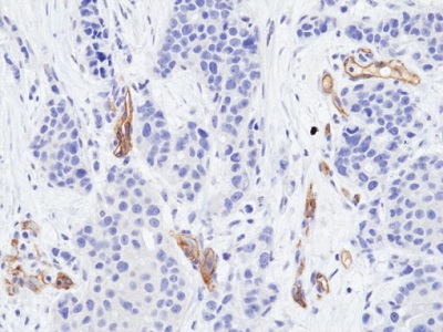 Immunohistochemical staining of formalin-fixed and paraffin-embedded human breast cancer tissue sections using anti-VEGFR2 Rabbit Monoclonal Antibody (Clone RM515) at 1:100 dilution for 1 hr at room temperature.