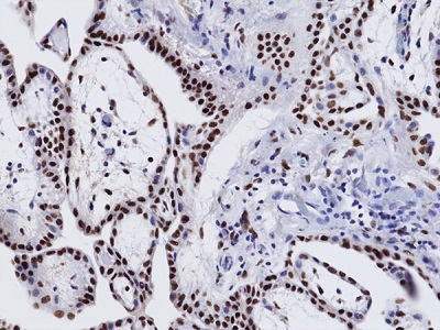 Immunohistochemical staining of formalin-fixed and paraffin-embedded human mesothelioma tissue sections using anti-WT1 Rabbit Monoclonal Antibody (Clone RM516) at 1:100 dilution for 1 hr at room temperature.