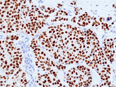 Immunohistochemical staining of formalin-fixed and paraffin-embedded human breast carcinoma tissue sections (ER+, PR+, Her2+; Stage IIA) using anti-TRPS1 Rabbit Monoclonal Antibody (Clone RM518) at 1:100 dilution, for 1 hr at room temperature.