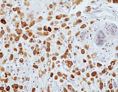 Immunohistochemical staining of formalin-fixed and paraffin-embedded human breast lobular cancer tissue section using anti-MGB1 Rabbit Monoclonal Antibody (Clone RM519) at 1:100 dilution, for 1 hr at room temperature.