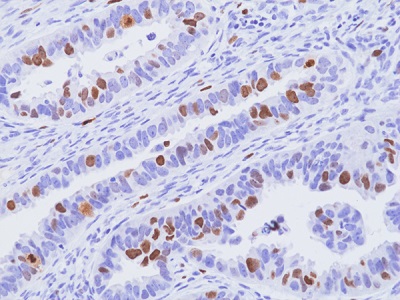 Immunohistochemical staining of formalin-fixed and paraffin-embedded human ovarian papillary serous carcinoma tissue sections, using anti-Ki67 rabbit monoclonal antibody (Clone RM521) at 1:100 dilution, for 1hr at room temperature.